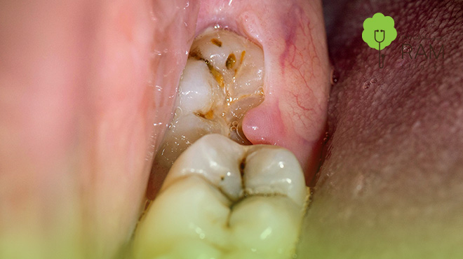 ضرس-العقل-المدفون