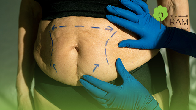الفرق-بين-نحت-الجسم-وشفط-الدهون