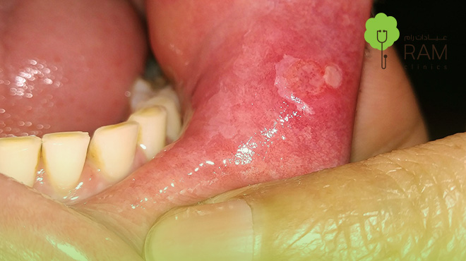 اعراض-سرطان-اللثة