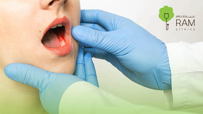 علامات-سرطان-اللثة