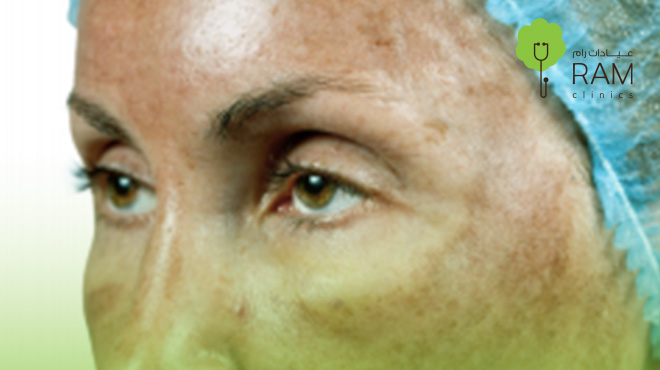 هل-التقشير-الكيميائي-مؤلم