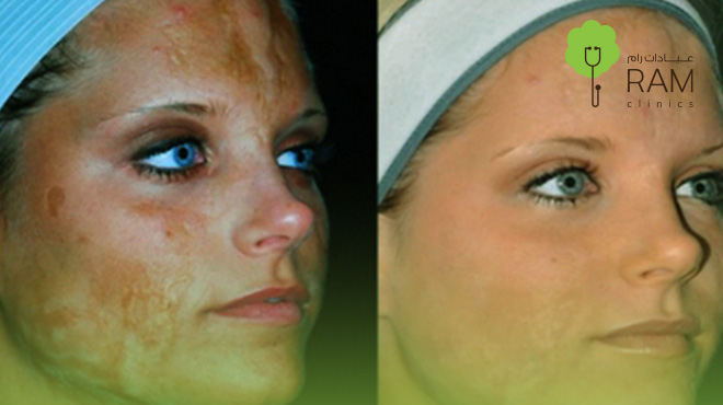 مراحل-التقشير-الكيميائي-للوجة-بالصور