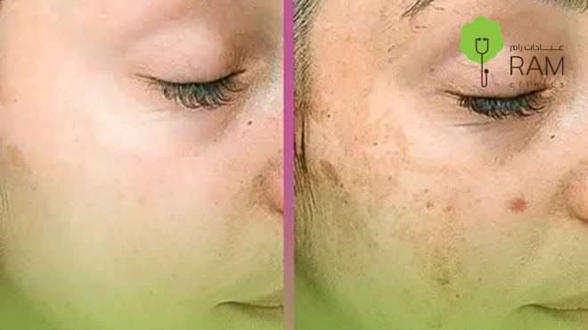 التقشير-الكيميائي-قبل-وبعد