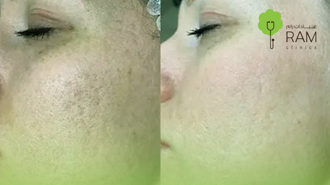 الليزر-الكربوني-للوجه