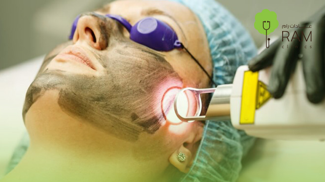 الليزر-الكربوني-للوجه