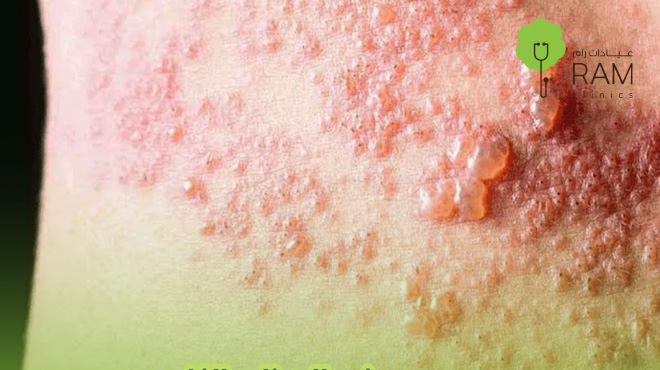 علاج-الحزام-الناري علاج-الحزام-الناري