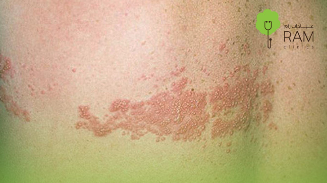 علاج-الحزام-الناري علاج-الحزام-الناري