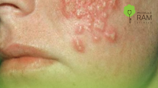 علاج-الحزام-الناري علاج-الحزام-الناري