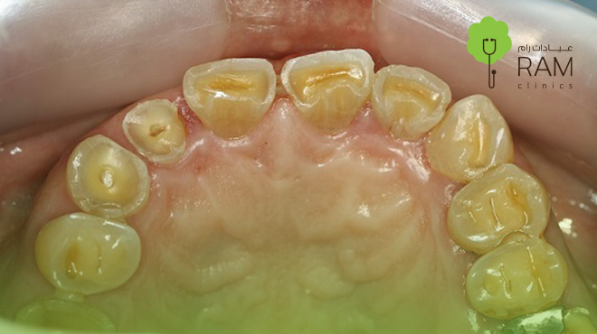 تآكل-الأسنان-الأمامية 