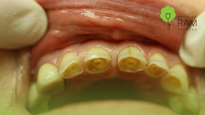 تآكل-الأسنان-الأمامية 