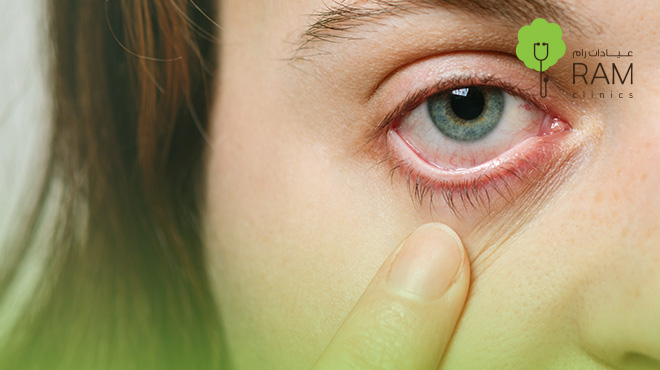 جفاف-العين جفاف-العين