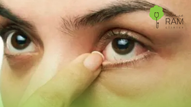 جفاف-العين جفاف-العين