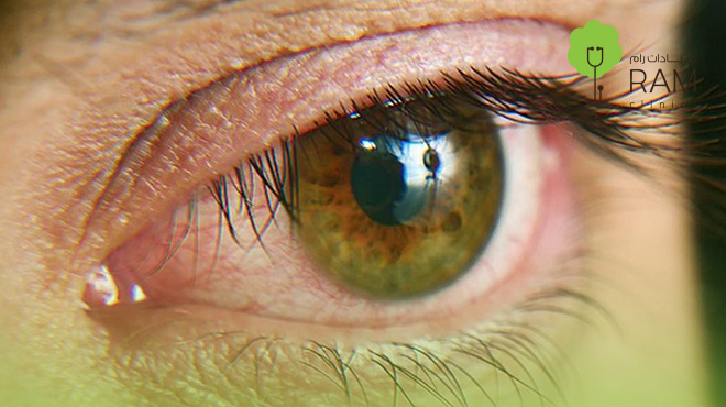 جفاف-العين جفاف-العين