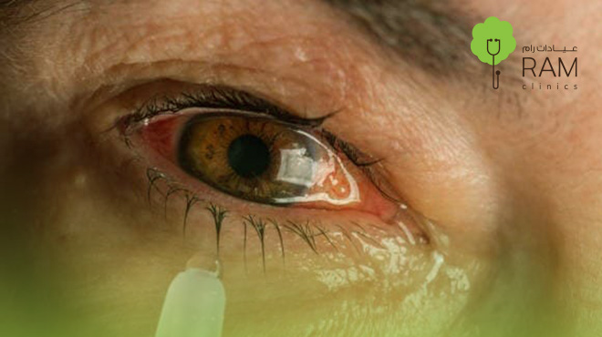 جفاف-العين جفاف-العين