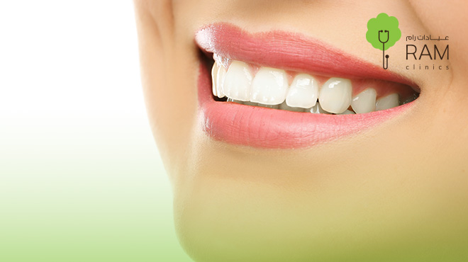 ابتسامة-هوليود