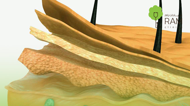 علاج-آثار-عمليات-الترقيع