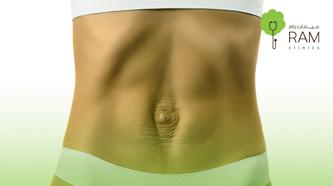 شكل-البطن-بعد-الانفصال-العضلي