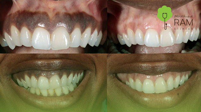 توريد-اللثة-بالليزر