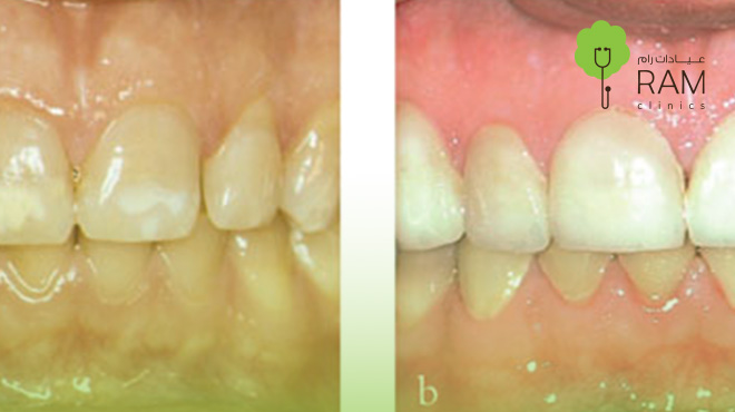 توريد-اللثة-قبل-وبعد
