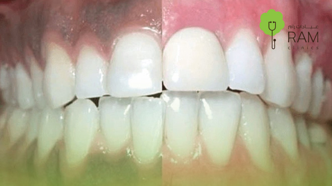 سعر-توريد-اللثة-بالليزر