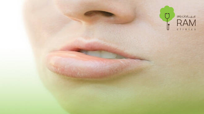 الشفايف-بعد-الفيلر الشفايف-بعد-الفيلر