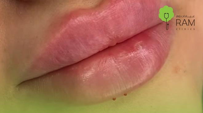 الشفايف-بعد-الفيلر الشفايف-بعد-الفيلر