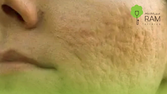 جلسة-تقطيع-الألياف