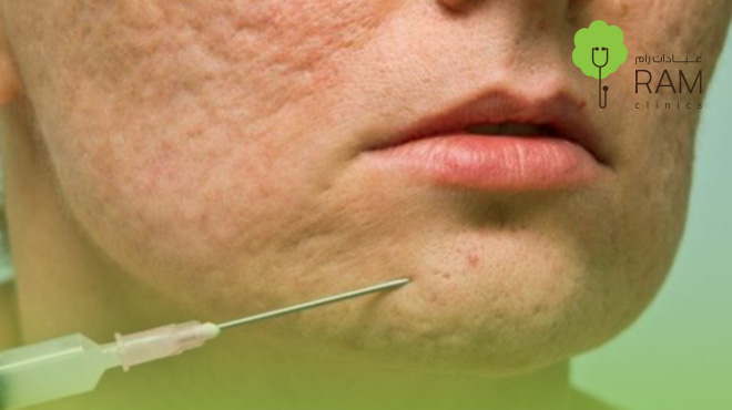 جلسة-تقطيع-الألياف