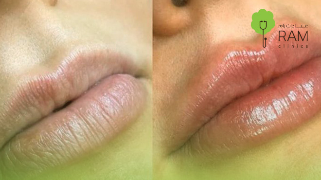 توريد-الشفايف 