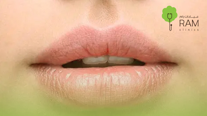 توريد-الشفايف 