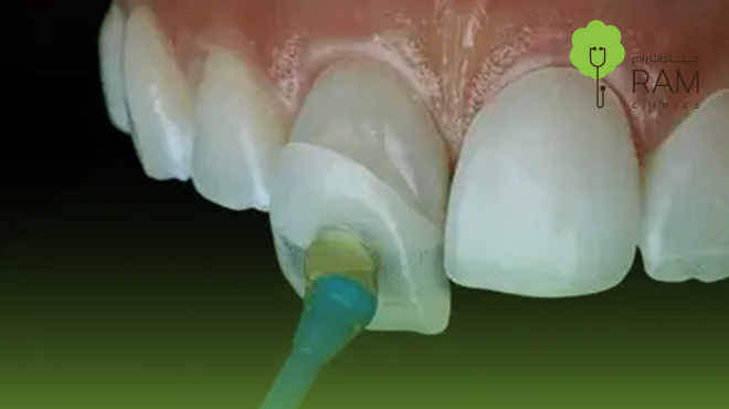 عدسات-الفينير-للاسنان عدسات-الفينير-للاسنان