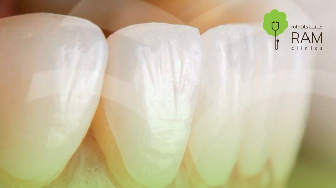 عدسات-الفينير-للاسنان عدسات-الفينير-للاسنان