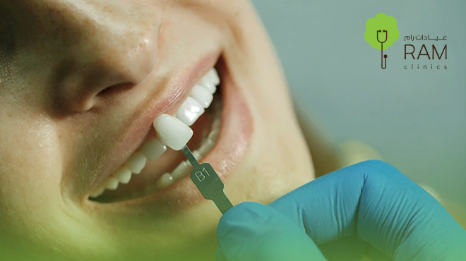 عدسات-الفينير-للاسنان عدسات-الفينير-للاسنان