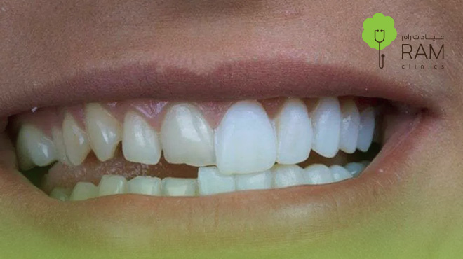 عدسات-الفينير-للاسنان عدسات-الفينير-للاسنان