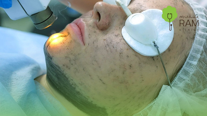 نضارة-البشرة-بالليزر-قبل-وبعد