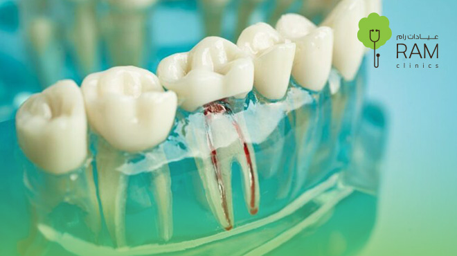 اعراض-عصب-الاسنان