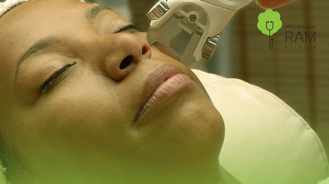 علاج-الكلف-بعد-الولادة-بالليزر