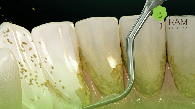 إزالة-جير-الأسنان-الأسود