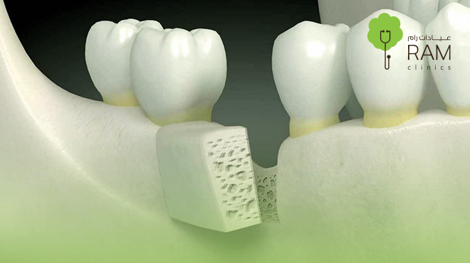 تجربتي-مع-زراعة-عظم-الفك