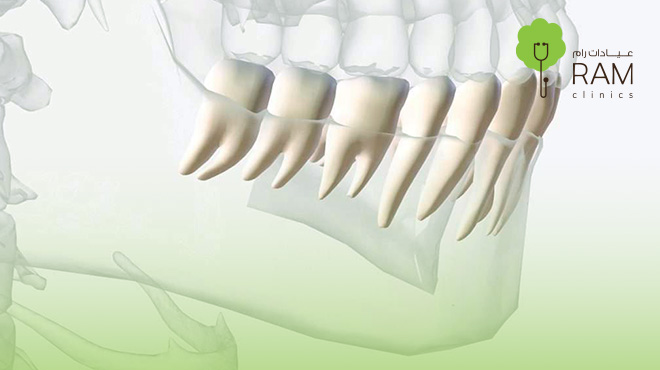 سعر-زراعة-عظم-الفك