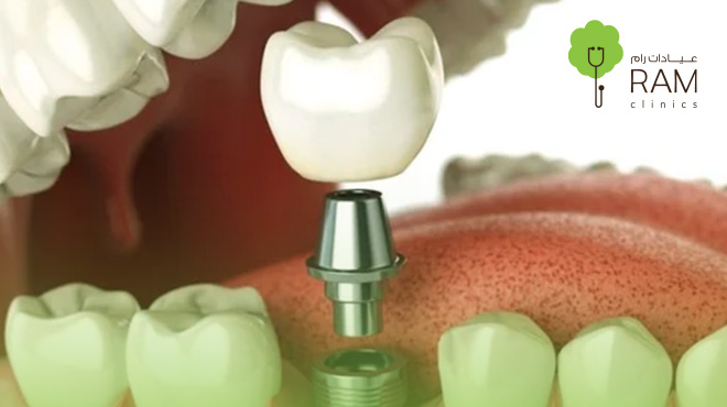 ماهي-زراعة-الاسنان-الفورية