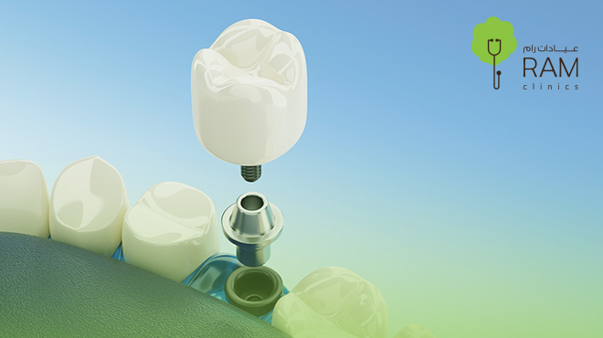 زراعة-الاسنان-الفورية