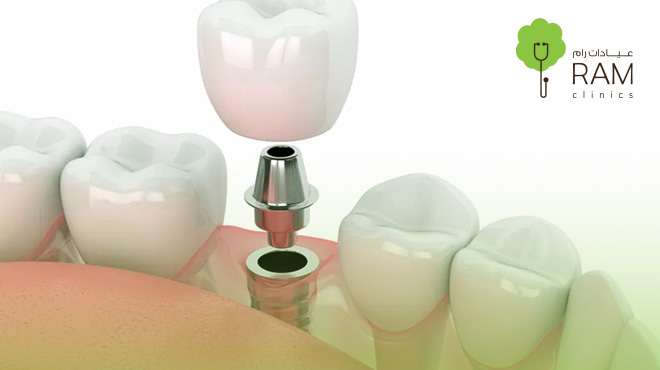 كيفية-زراعة-الاسنان-الفورية