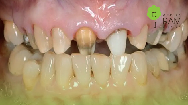 تكلس-جذور-الأسنان 