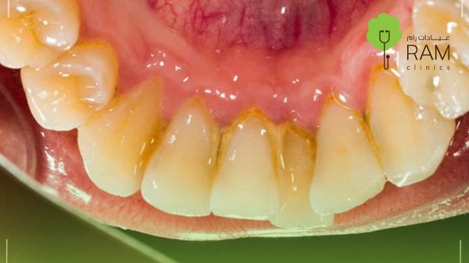 شكل-تكلس-الأسنان 