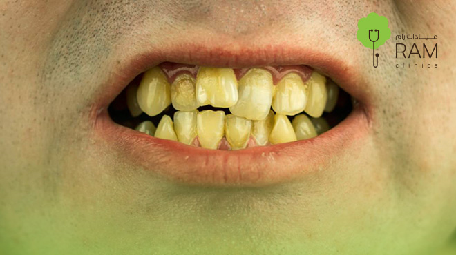 أسباب-تكلس-جذور-الأسنان