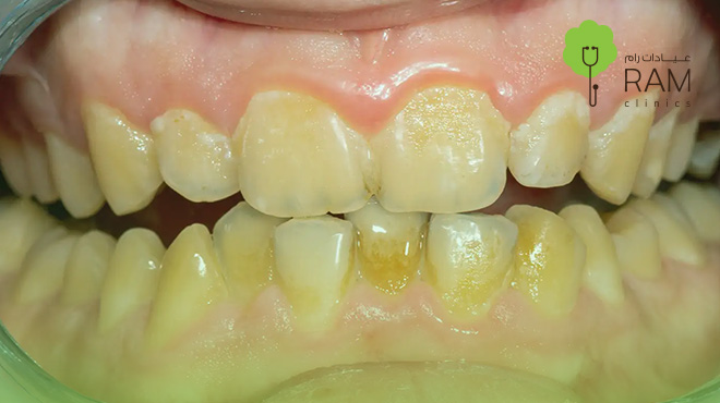 أضرار-تكلس-الأسنان