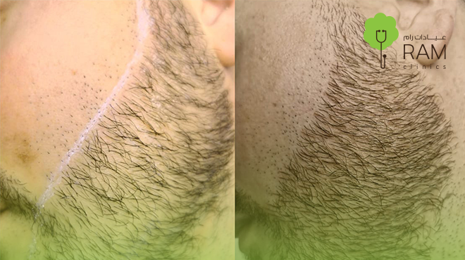 تحديد-اللحية-بالليزر-قبل-وبعد