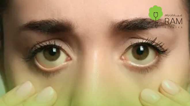 صورة-توضح-اعرض-ارتفاع-الكوليسترول-على-الوجه