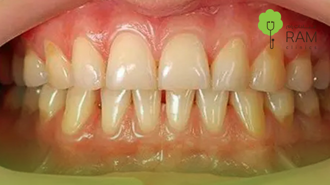 صورة-توضح-إحدى-درجات-انحسار-اللثة